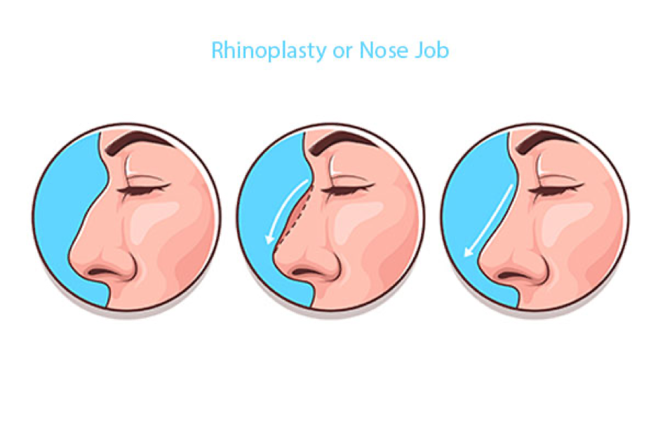 Nose job in Turkey - The Iran Project